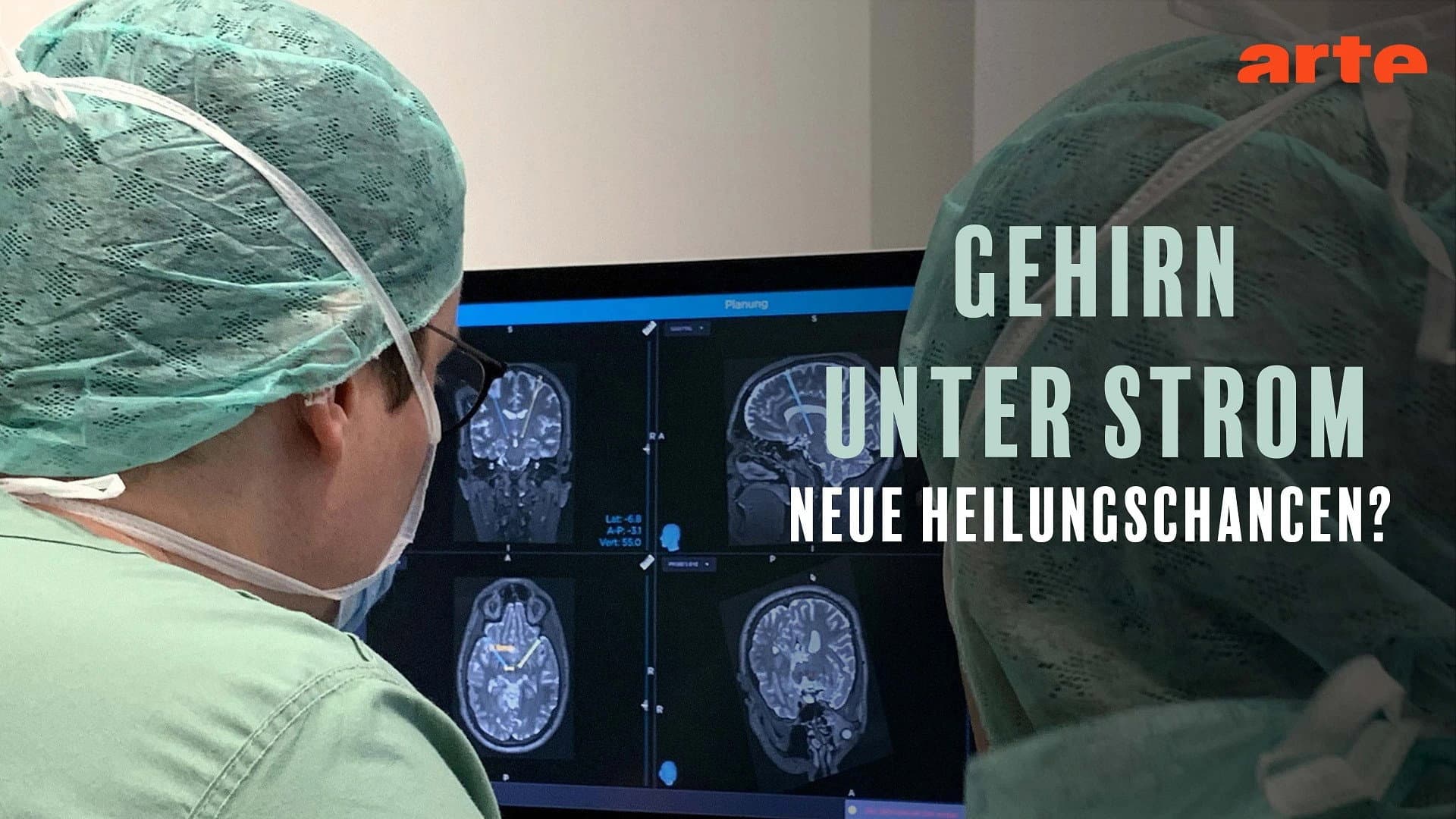 Gehirn unter Strom - Hilfe bei Depression, Epilepsie und Parkinson?
